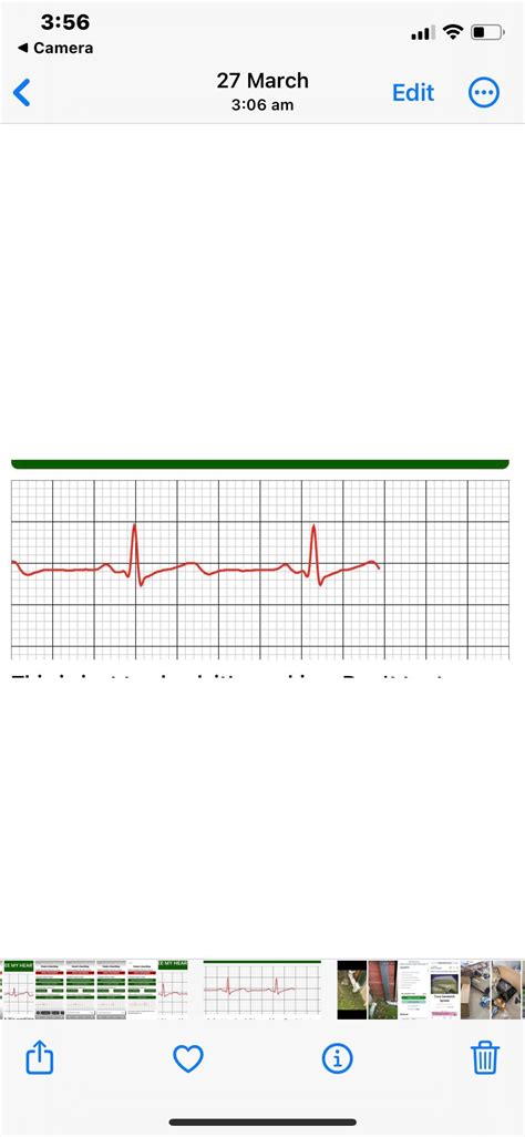 Cardiologist found 3 leaking heart valves.. : r/AFIB