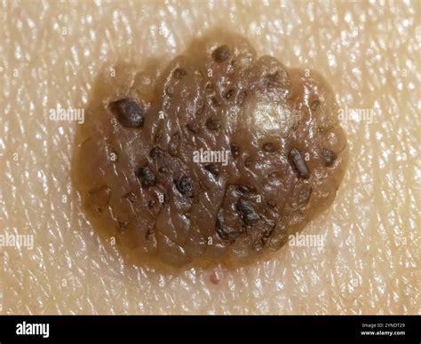 A detailed macro view of a mole with potential indications of malignant ...