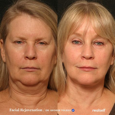 Jowls | Sagging skin face, Jowl, Face firming