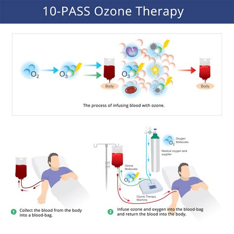 10-Pass Ozone Therapy - Biologix Center for Optimum Health
