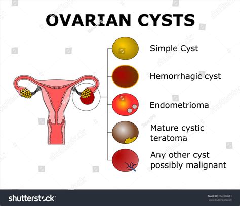 Ovarian Cystscolor Vector Illustration Stock Vector 666982843 - Shutterstock
