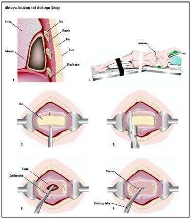 Carbuncle Drainage Procedure 的图像结果