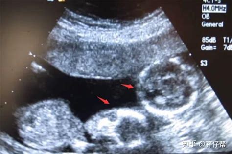连载（十五）|圆圈妈双胞胎怀孕过程第18周 - 知乎