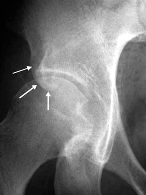 Operative treatment of hip impingement caused by hypertrophy of the anterior inferior iliac ...