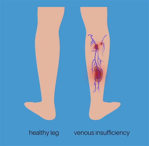 Venous Reflux In The Legs _ Causes and Treatments for Superficial Venous Insufficiency – ZWLTEA