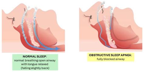 Obstructive Sleep Apnea