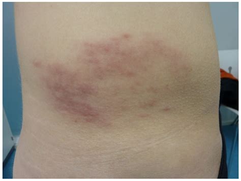 Annular Erythemas and Purpuras