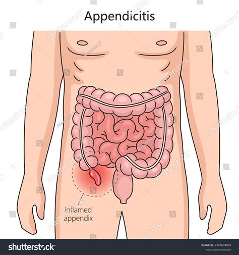 Where Is Your Apendix