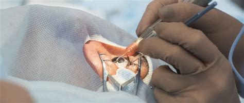 Retina Surgery