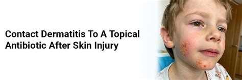 Contact Dermatitis to a Topical Antibiotic after Skin Injury