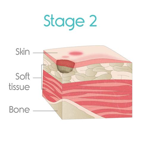 Bedsores pressure ulcers treatments stages causes and pictures – Artofit