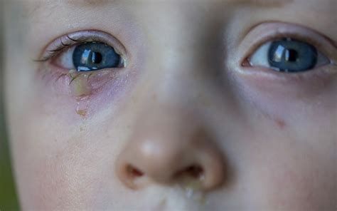 Baby's Eye Discharge. Is It Cause For Alarm?
