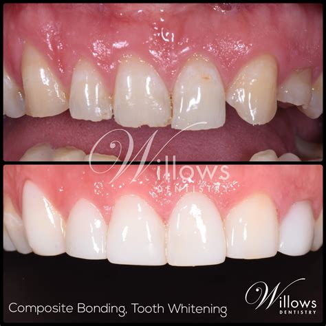 Composite Bonding - Willows Dentistry