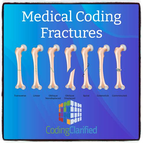 Medical Coding Fractures | Coding Clarified