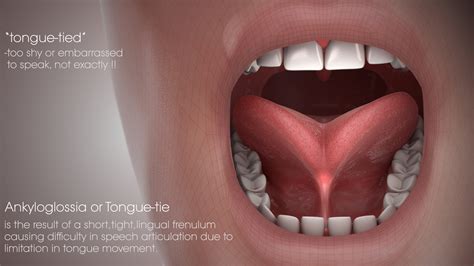Adults Tongue Tie