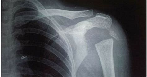 Woman Able To Rotate Arm A Painful 180 Degrees After Her Shoulder Bone ...