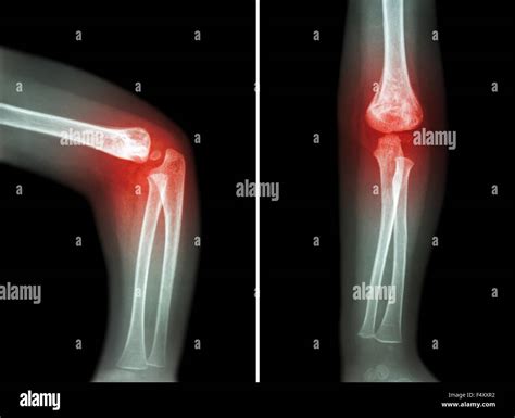 Rheumatoid arthritis , Gouty arthritis ( film x-ray child 's elbow with arthritis at elbow ...