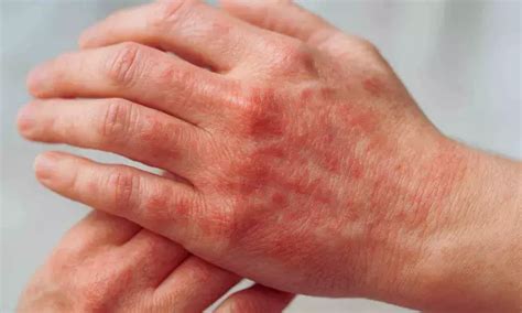 Tralokinumab Shows Sustained Efficacy in Hand Atopic Dermatitis: Study