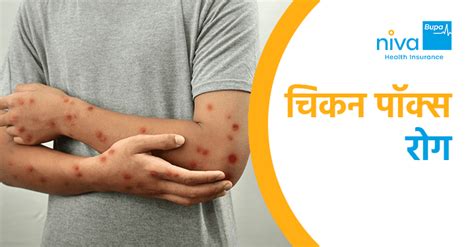 Chicken Pox Meaning In Hindi: चेचक के लक्षण, कारण और इलाज - पूरी जानकारी