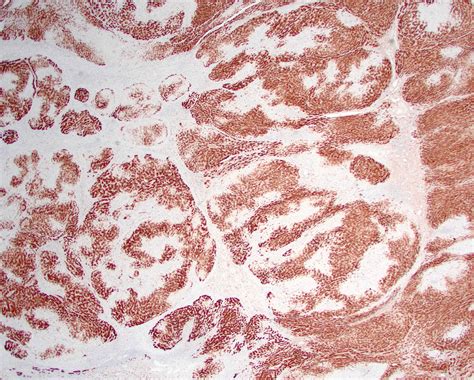 Histologia De Hiperplasia Nodular Focal