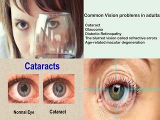 Image result for Types of Vision Problems
