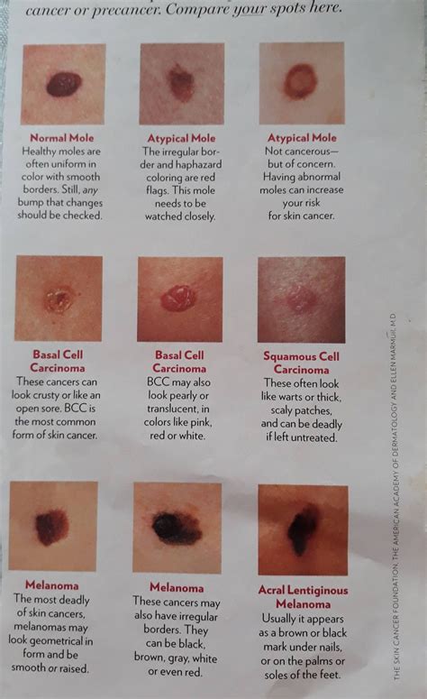 Cancerous Moles Vs Normal Moles