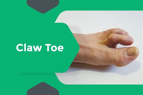 Get Relief from Claw Toe Pain with Effective Treatments