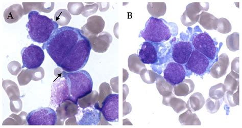 Acute Myelomonocytic Leukemia
