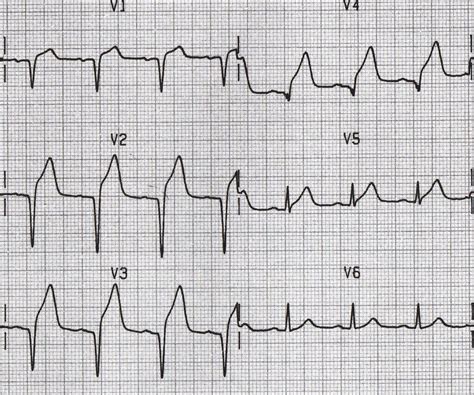 anterior STEMI q waves. Q waves are considered pathological if: > 40 ms ...