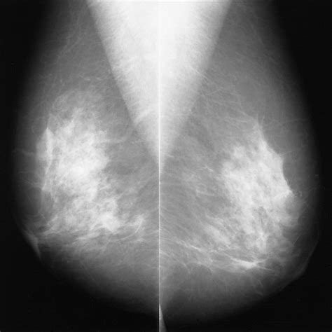 Computer-aided Detection Output on 172 Subtle Findings on Normal Mammograms Previously Obtained ...
