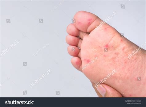 Red Rash On Feet Child Caused Stock Photo 1501158023 | Shutterstock
