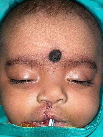 Dr. Subhasis Saha - Expert in Pediatric Plastic Surgery - India ...