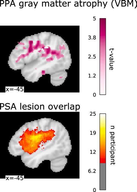 Image result for Example of Non-Fluent PPA