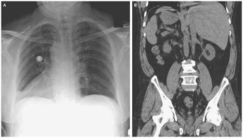 Case of Situs Inversus Totalis-A report