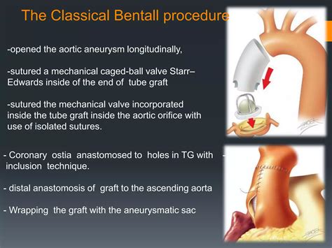 Aortic root surgery. Bentall operation | PPTX | Death, Injury, or ...