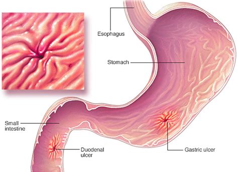 Helicobacter Pylori Infection, Bacteria - Symptoms, Test, Treatment