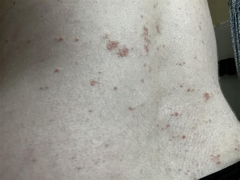 I would love some help. Rash that spread from torso onto back and arms over a period of two ...