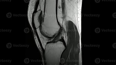 Knee Anatomy Mri