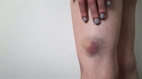 Why Do I Bruise Easily? Doctors Explain Easy Bruising