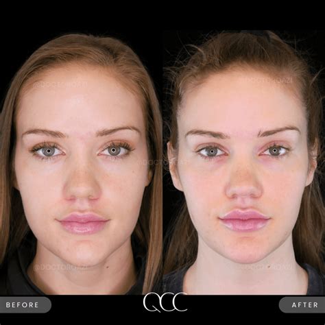 Masseter Botox using Dysport