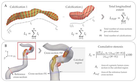Morphometry of Intracranial Carotid Artery Calcifications in Patients ...