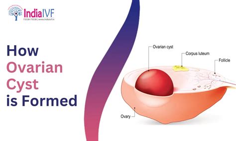 How Ovarian Cyst is Formed: Causes and Development Explained