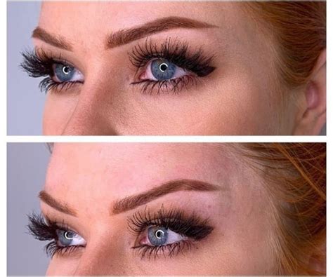 Image result for Fox Eye Thread Lift Procedure