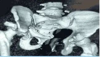 Fractura pélvica acetabular en Medicover