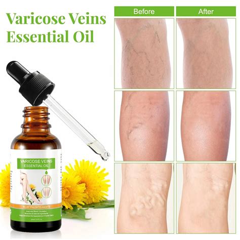 Repair-Venous-Injury-Varicose-Essence-Essential-Oils-Legs-Care-Essential-Oil-Leg-Moisturizing ...