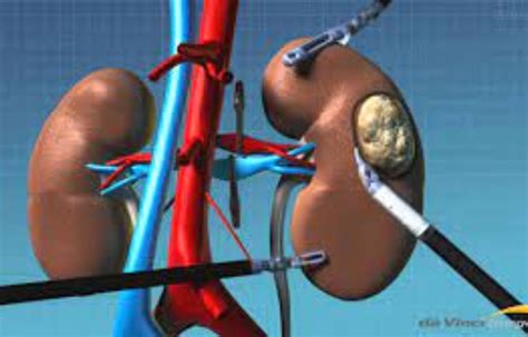 Pembrolizumab effective as post-nephrectomy adjuvant therapy in clear ...