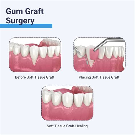What Is Gum Graft Surgery