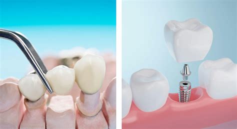 Dental Bridge vs. Dental Implant: Which Is Right for You?