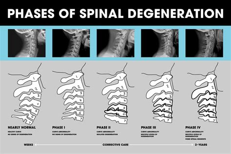 Spinal Degeneration - MIND TWEAK