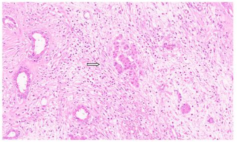 Update on the Pathology of Pediatric Liver Tumors: A Pictorial Review
